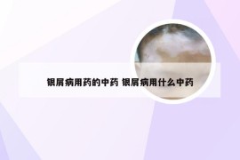 银屑病用药的中药 银屑病用什么中药