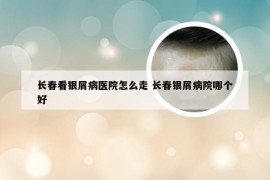 长春看银屑病医院怎么走 长春银屑病院哪个好