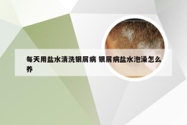 每天用盐水清洗银屑病 银屑病盐水泡澡怎么养