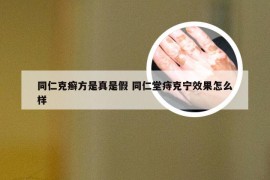 同仁克癣方是真是假 同仁堂痔克宁效果怎么样