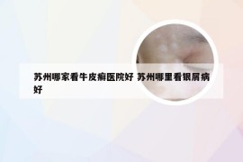 苏州哪家看牛皮癣医院好 苏州哪里看银屑病好