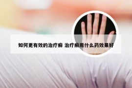 如何更有效的治疗癣 治疗癣用什么药效果好