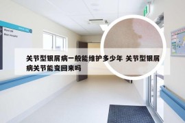 关节型银屑病一般能维护多少年 关节型银屑病关节能变回来吗