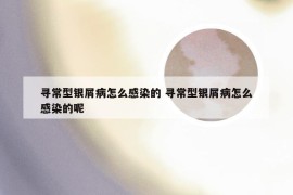 寻常型银屑病怎么感染的 寻常型银屑病怎么感染的呢