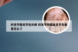 肘关节膝关节处长癣 肘关节和膝盖关节生癣是怎么了