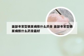 面部寻常型银屑病擦什么药膏 面部寻常型银屑病擦什么药膏最好