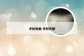 手肘处癣 手肘长藓