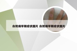 白斑病早期症状图片 白斑病早期症状图片