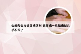 头癣和头皮银屑病区别 银屑病一旦结痂就几乎不长了