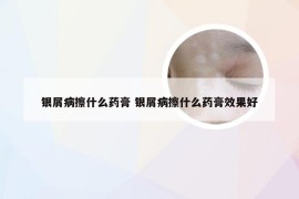 银屑病擦什么药膏 银屑病擦什么药膏效果好