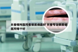 长春哪所医院看银屑病最好 长春专治银屑病医院哪个好