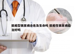 脓疱型银屑病会危及生命吗 脓疱性银屑病能治好吗