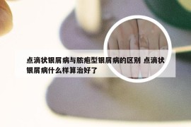 点滴状银屑病与脓疱型银屑病的区别 点滴状银屑病什么样算治好了