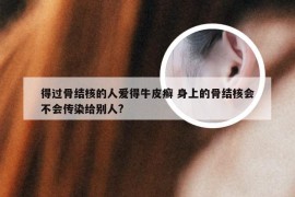 得过骨结核的人爱得牛皮癣 身上的骨结核会不会传染给别人?