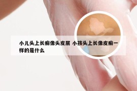 小儿头上长癣像头皮屑 小孩头上长像皮癣一样的是什么