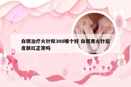 白斑治疗火针和308哪个好 白斑用火针后皮肤红正常吗