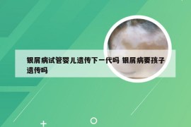 银屑病试管婴儿遗传下一代吗 银屑病要孩子遗传吗