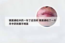 银屑病吃中药一年了还没好 银屑病吃了一个月中药效果不明显