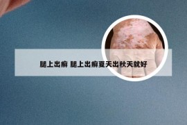 腿上出癣 腿上出癣夏天出秋天就好