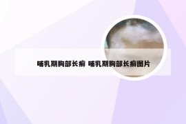 哺乳期胸部长癣 哺乳期胸部长癣图片