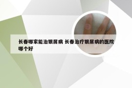 长春哪家能治银屑病 长春治疗银屑病的医院哪个好