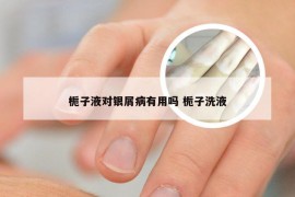 栀子液对银屑病有用吗 栀子洗液