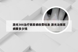 激光308治疗银屑病收费标准 激光治银屑病要多少钱