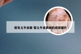 新生儿牛皮廨 婴儿牛皮肤癣的症状图片