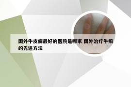 国外牛皮癣最好的医院是哪家 国外治疗牛癣的先进方法