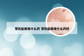 受伤起癣用什么药 受伤起癣用什么药好