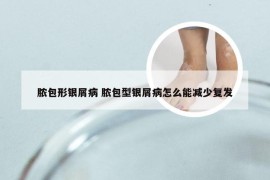 脓包形银屑病 脓包型银屑病怎么能减少复发