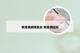 银屑病病情复杂 银屑病经历