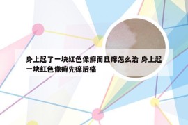 身上起了一块红色像癣而且痒怎么治 身上起一块红色像癣先痒后痛