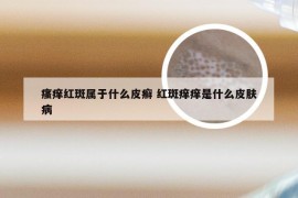 瘙痒红斑属于什么皮癣 红斑痒痒是什么皮肤病