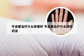 牛皮廨治疗什么样算好 牛皮廨治疗什么特效药膏