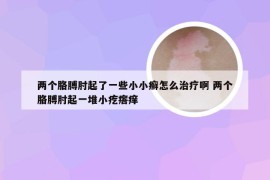 两个胳膊肘起了一些小小癣怎么治疗啊 两个胳膊肘起一堆小疙瘩痒