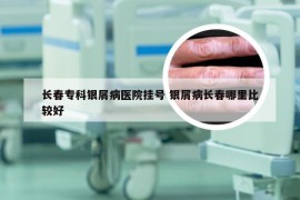 长春专科银屑病医院挂号 银屑病长春哪里比较好