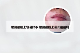 银屑病脸上容易好不 银屑病脸上会长痘痘吗