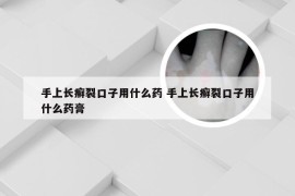 手上长癣裂口子用什么药 手上长癣裂口子用什么药膏