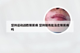 坚持运动战胜银屑病 坚持锻炼能治愈银屑病吗