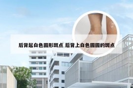 后背起白色圆形斑点 后背上白色圆圆的斑点