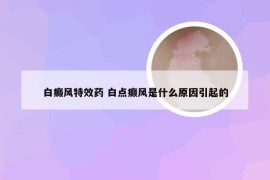 白癜风特效药 白点癫风是什么原因引起的