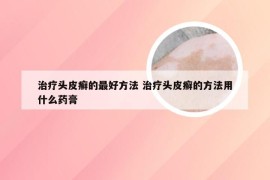 治疗头皮癣的最好方法 治疗头皮癣的方法用什么药膏