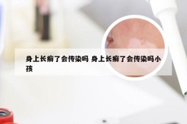 身上长癣了会传染吗 身上长癣了会传染吗小孩