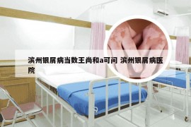 滨州银屑病当数王尚和a可问 滨州银屑病医院