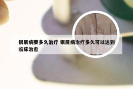 银屑病要多久治疗 银屑病治疗多久可以达到临床治愈