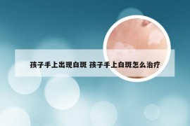 孩子手上出现白斑 孩子手上白斑怎么治疗