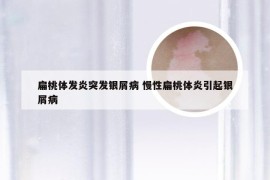 扁桃体发炎突发银屑病 慢性扁桃体炎引起银屑病