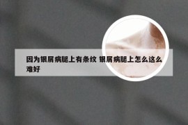 因为银屑病腿上有条纹 银屑病腿上怎么这么难好