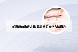 蛇斑癣的治疗方法 蛇斑癣的治疗方法图片